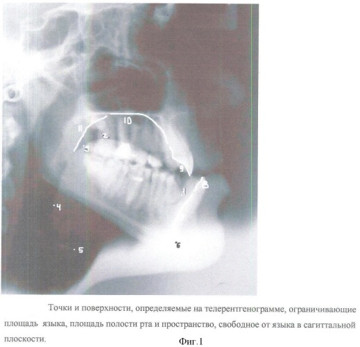 Способ диагностики аномалий зубочелюстной системы (патент 2360604)
