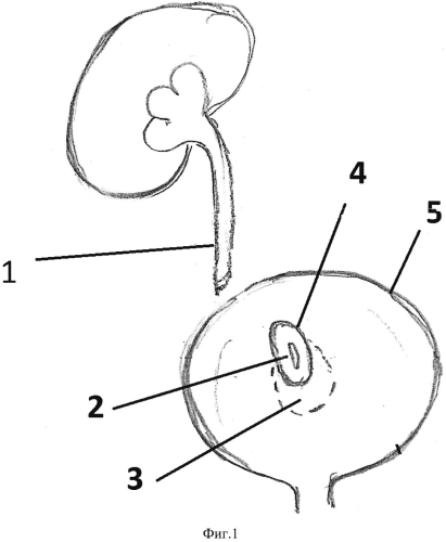 Способ восстановления мочеточника при трансплантации почки (патент 2578384)