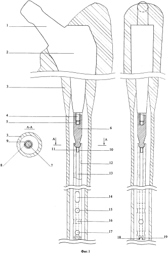 Комплект для эндопротезирования тазобедренного сустава (патент 2591534)