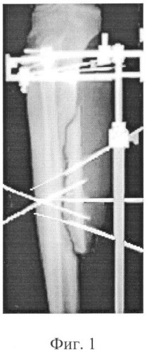 Способ остеосинтеза при лечении больных с ишемическими поражениями конечностей (патент 2354321)