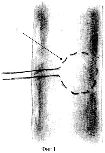 Способ временного артериального сосудистого байпаса при резекции висцеральных ветвей брюшной аорты (патент 2321357)