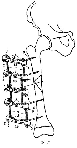Аппарат для лечения оскольчатых переломов длинных трубчатых костей (патент 2271168)