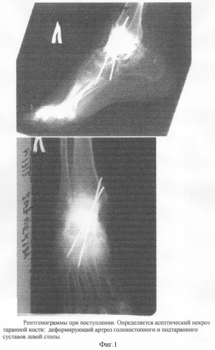 Способ оперативного лечения многооскольчатых переломов и переломовывихов таранной кости (патент 2303414)