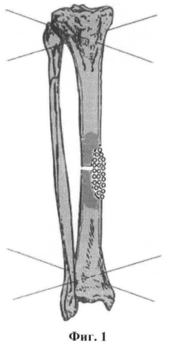 Способ пластики дефектов длинных трубчатых костей (патент 2463012)