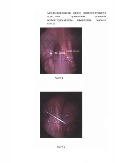 Модифицированный способ лапароскопического чрескожного, пункционного ушивания необлитерированного внутреннего пахового кольца у детей (патент 2633946)