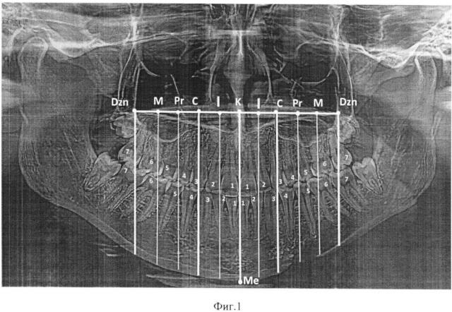 Способ определения положения постоянных зубов на ортопантомограммах челюстей (патент 2649212)