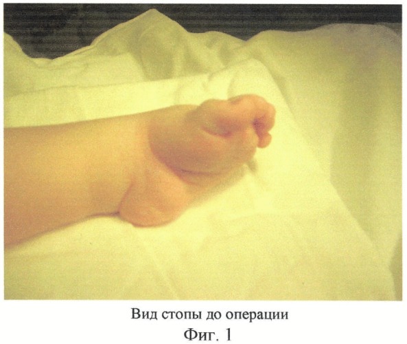 Способ лечения и профилактики вторичных деформаций при хирургической коррекции косолапости у детей первого года жизни (патент 2408312)