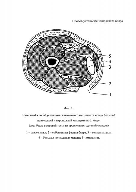 Способ установки имплантата бедра (патент 2626271)