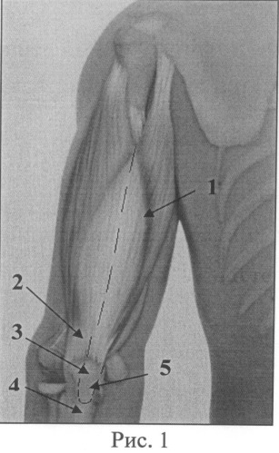 Способ транспозиции длинной головки трехглавой мышцы плеча в позицию двуглавой мышцы плеча у детей с артрогрипозом (патент 2503423)