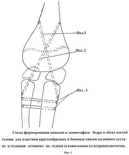Способ лечения врожденного диастаза (расщепления) коленного сустава у детей (патент 2407474)
