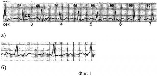 Способ диагностики внутрипредсердной блокады i степени у лиц молодого возраста с тахикардией (патент 2485882)
