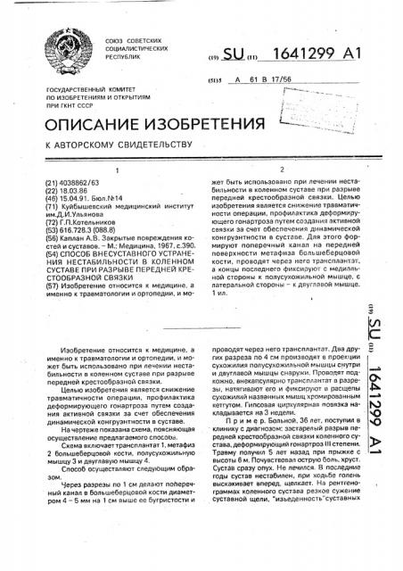 Способ внесуставного устранения нестабильности в коленном суставе при разрыве передней крестообразной связки (патент 1641299)