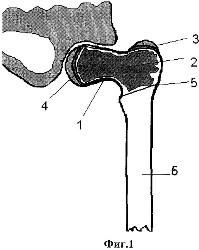 Способ лечения кистозных образований и опухолей проксимального отдела бедренной кости (патент 2305500)