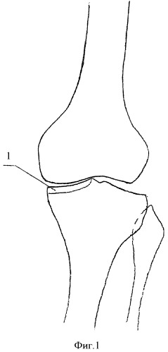 Способ лечения деформирующего артроза коленного сустава (патент 2412667)