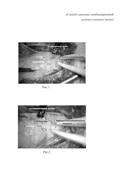 Способ удаления люмбосакральной липомы спинного мозга методом тракционной бикоагуляционной диссекции (патент 2611765)