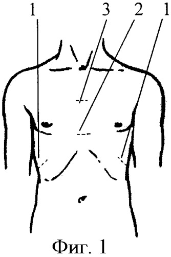 Способ лечения врожденной килевидной деформации грудной клетки в сочетании с ладьевидной деформацией реберных дуг (патент 2373879)