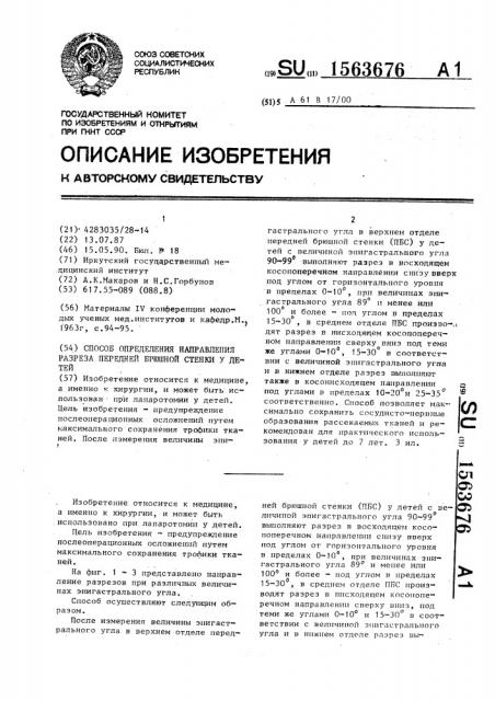 Способ определения направления разреза передней брюшной стенки у детей (патент 1563676)