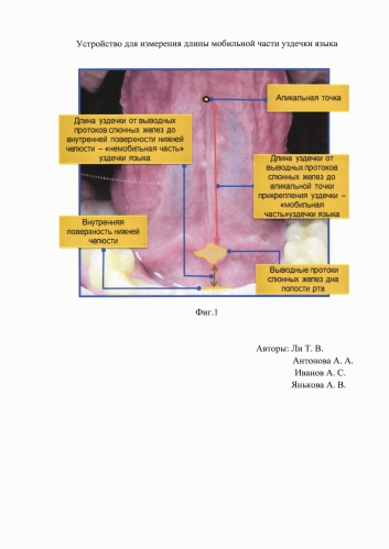 Устройство для измерения длины части уздечки языка (патент 2579279)