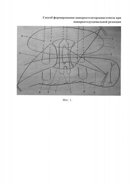 Способ формирования панкреатоэнтероанастомоза при панкреатодуоденальной резекции (патент 2655503)