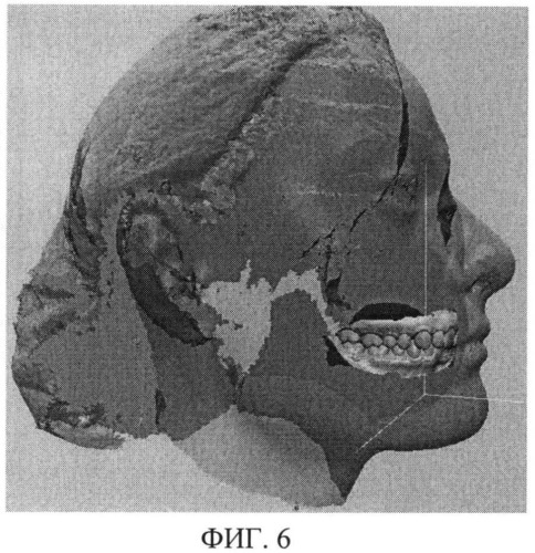 Способ компьютерной визуализации зубных рядов в голове путем сопоставления цифровых изображений (патент 2496445)