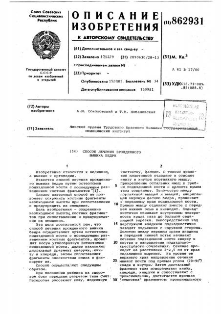 Способ лечения врожденного вывиха бедра (патент 862931)
