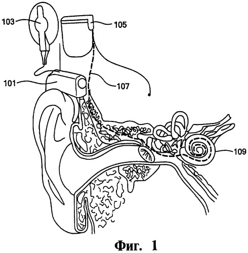 Кохлеарная протезирующая система, система стимуляции и машиночитаемый носитель информации (варианты) (патент 2440156)
