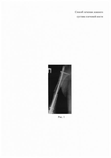 Способ лечения ложного сустава плечевой кости (патент 2638427)