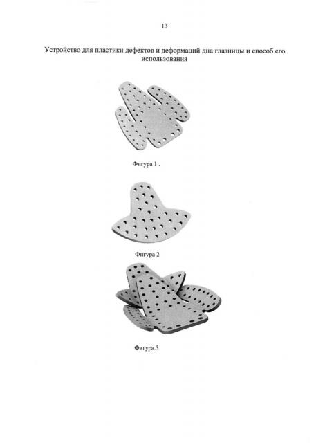 Устройство для пластики дефектов и деформаций дна глазницы и способ его использования (патент 2613443)