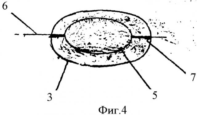 Искусственный хрусталик глаза (патент 2346668)