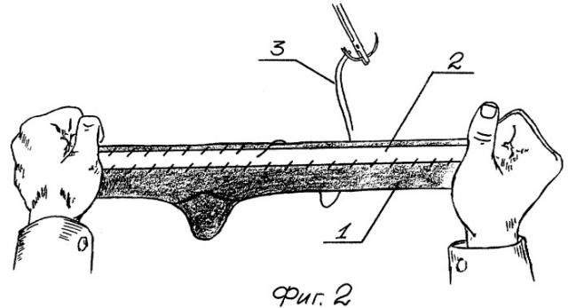 Устройство для коррекции паралитической эквинусной деформации стопы (патент 2277394)