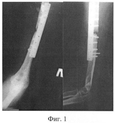 Способ лечения несросшихся переломов и ложных суставов длинных костей (патент 2383309)