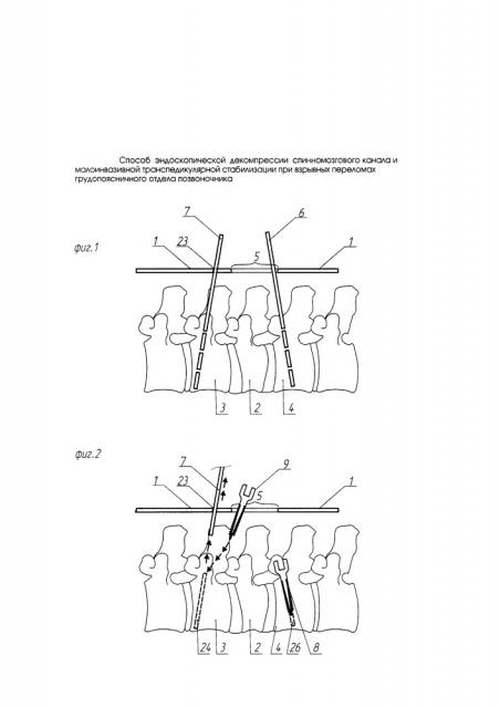 Способ эндоскопической декомпрессии спинномозгового канала и малоинвазивной транспедикулярной стабилизации при взрывных переломах грудопоясничного отдела позвоночника (патент 2649826)