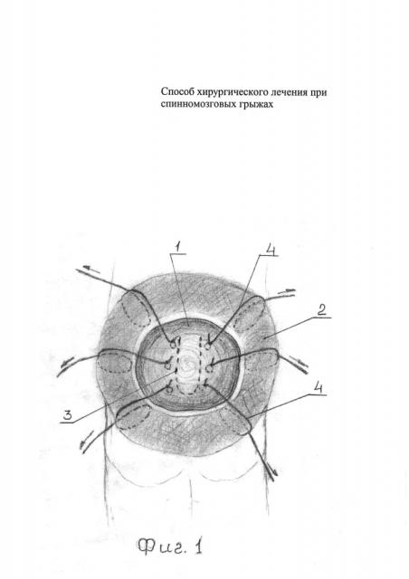 Способ хирургического лечения при спинномозговых грыжах (патент 2645246)