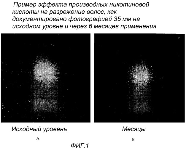 Способ лечения нарушений роста волос, таких как облысение по женскому типу, и применяемые в нем композиции (патент 2431485)