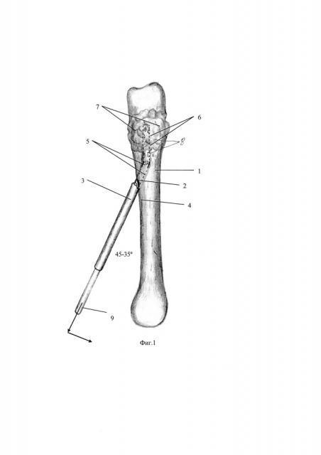 Способ лечения фиброзно-кистозной дисплазии костной ткани у детей (патент 2621424)