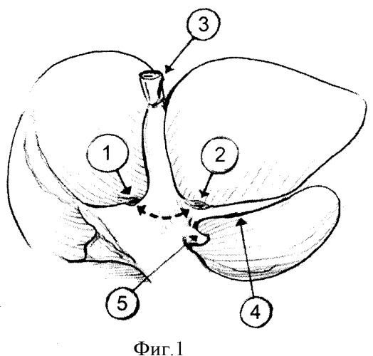 Способ левосторонней гемигепатэктомии (патент 2416368)