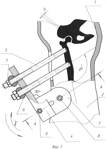 Устройство для декомпрессии бедренной кости (патент 2500363)