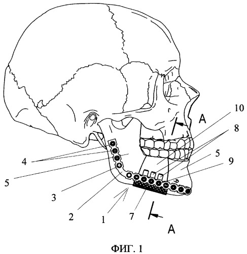 Устройство для устранения дефектов и деформаций кости нижней челюсти (патент 2387410)