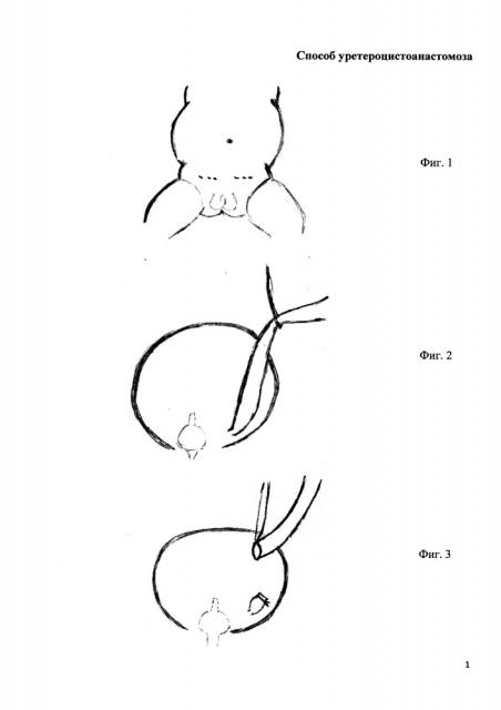 Способ уретероцистоанастомоза (патент 2655123)
