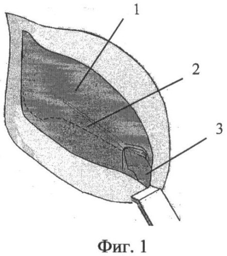 Способ пластики при паховых грыжах (патент 2452405)
