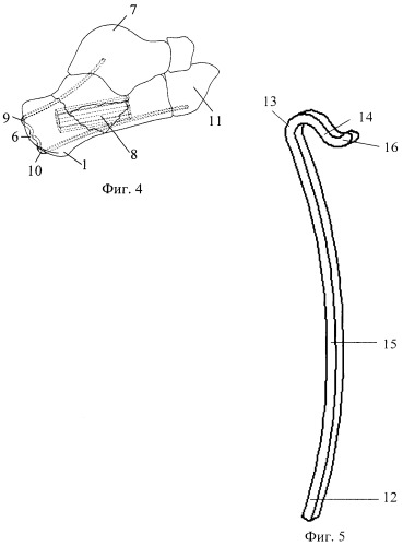 Способ хирургического лечения внутрисуставного компрессионного перелома пяточной кости и скоба для его осуществления (патент 2535451)