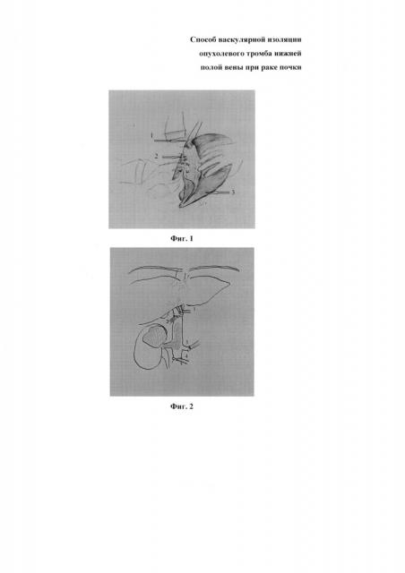Способ васкулярной изоляции опухолевого тромба нижней полой вены при раке почки (патент 2661081)
