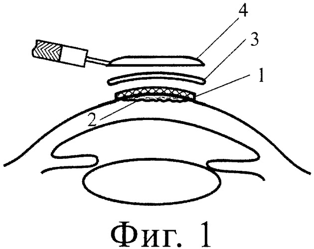 Способ лечебной аппликации роговицы биопластическим материалом "гиаматрикс" (патент 2485919)