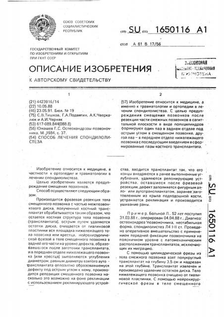 Способ лечения спондилолистеза (патент 1650116)