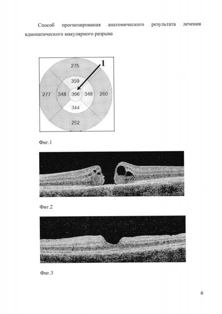 Способ прогнозирования анатомического результата лечения идиопатического макулярного разрыва (патент 2597571)