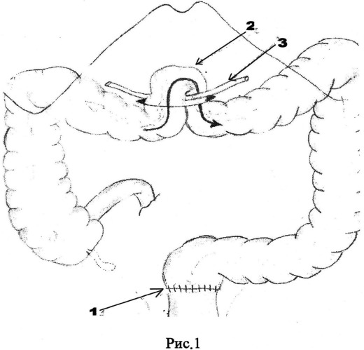 Способ выведения трансверзостомы лапароскопическим методом при раке прямой кишки (патент 2539660)