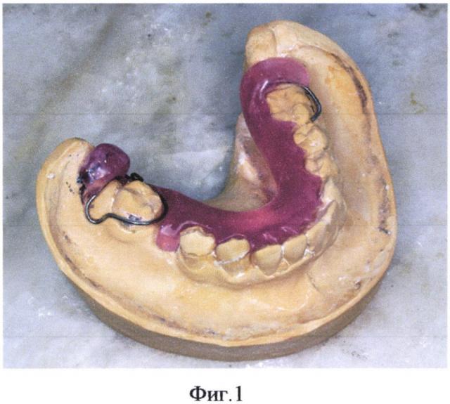 Способ изготовления ортодонтического аппарата и ортодонтический аппарат для дистализации первого постоянного моляра с активными элементами из никелид титана (патент 2635961)