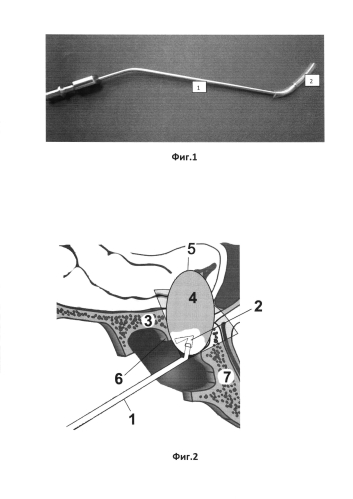 Способ удаления аденом гипофиза при транссфеноидальном хирургическом доступе (патент 2587962)