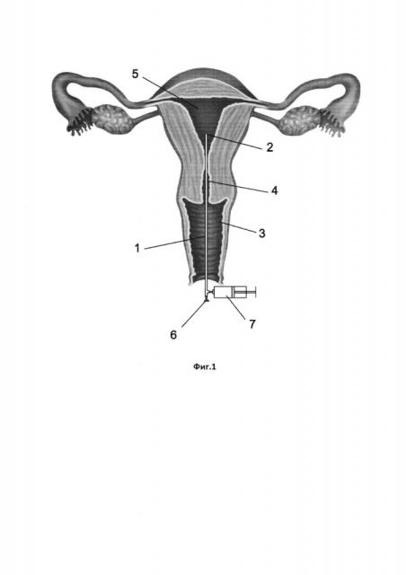 Способ введения лекарственных средств в жидкой или газовой форме м.г. шнейдермана при лечении хронического эндометрита (патент 2624161)