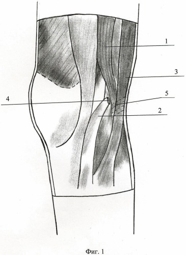 Способ хирургического лечения застарелого разрыва связки надколенника (патент 2471446)